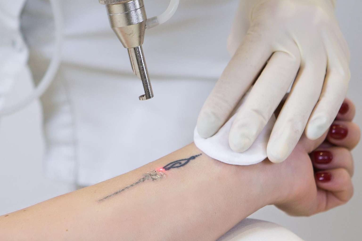 El Yag Láser para eliminar tatuajes se ofrece en el centro Bodyslim