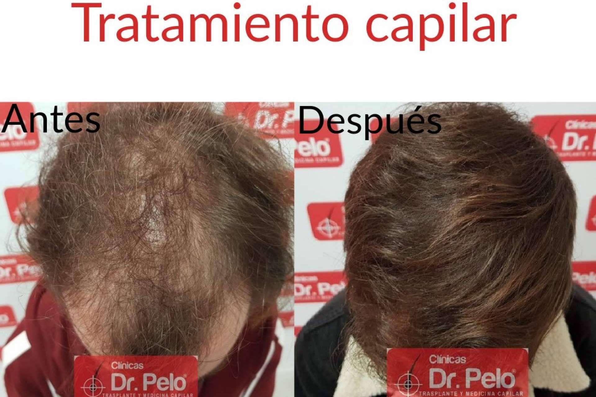 Tratamientos capilares de todo tipo en las Clínicas Dr. Pelo