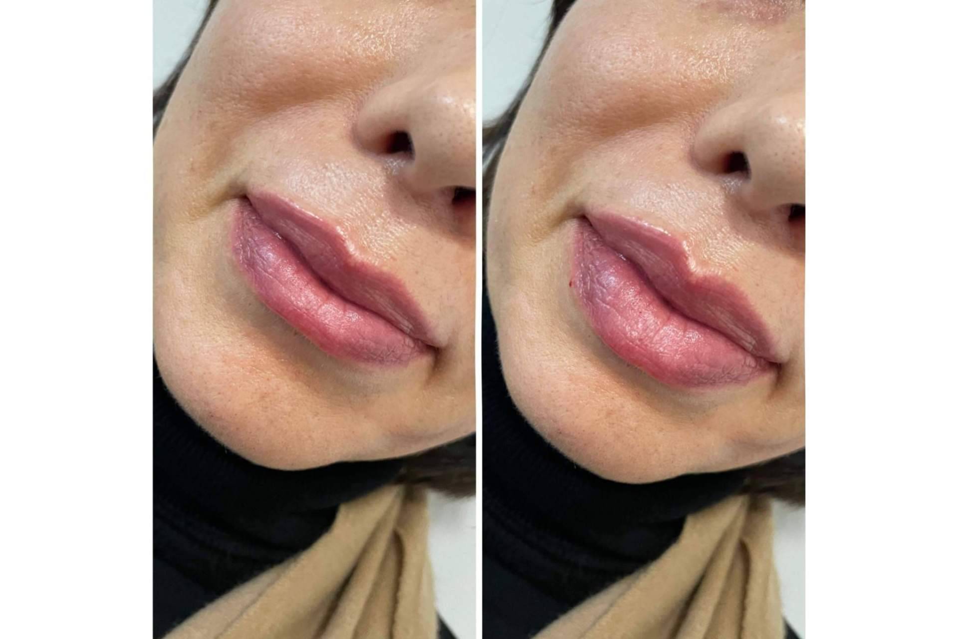 ¿Es posible realizarse un aumento de labios en Madrid con resultados naturales?, por la Dra. Cecilia Arthur
