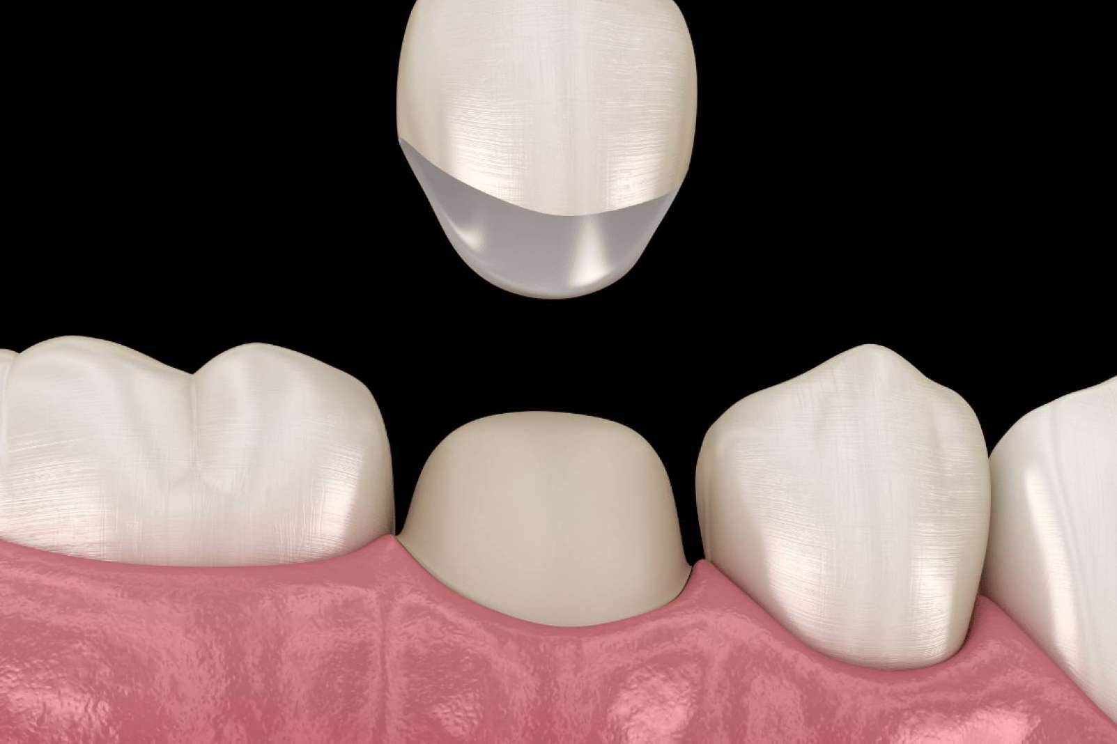 La Clínica Dental Ruiz de Gopegui coloca coronas dentales, una solución duradera y estética para recuperar la sonrisa perfecta