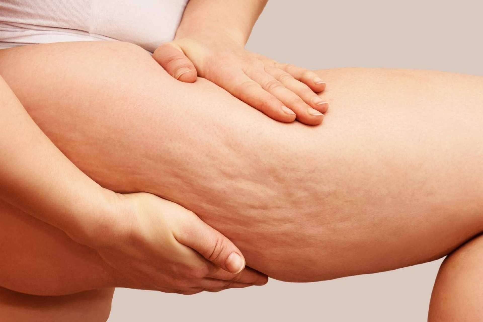 Las principales causas y soluciones de la celulitis